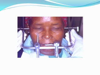 4 &amp; 5 jaw relation 1 &amp; 2