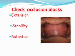 Check occlusion blocks
Extension
Stability
Retention
 