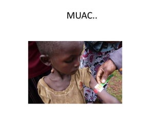 MUAC..
33
 