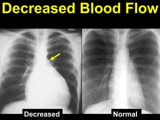 Imaging of Congenital heart diseases.pdf