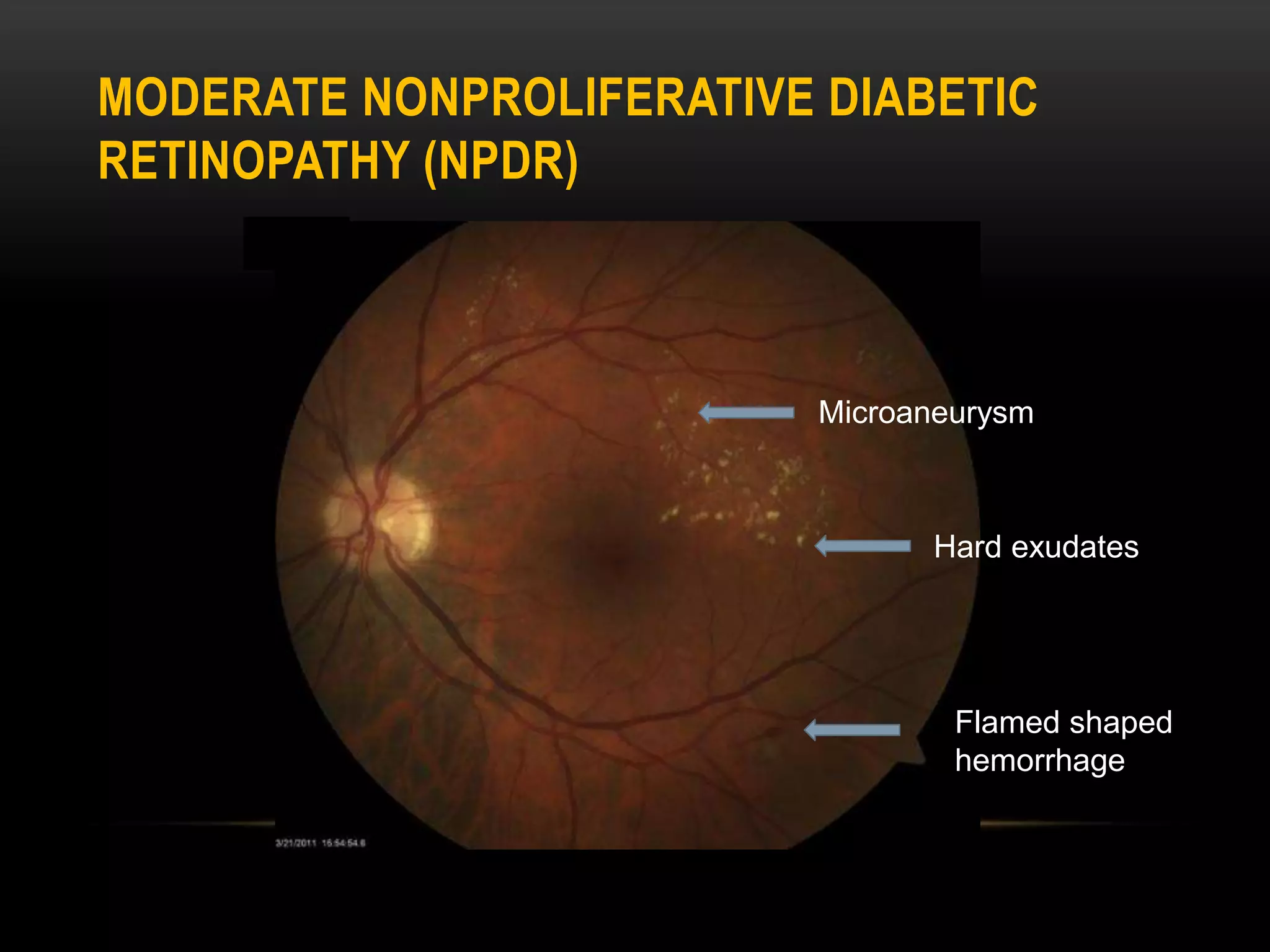 MODERATE NONPROLIFERATIVE DIABETIC
RETINOPATHY (NPDR)
Hard exudates
Flamed shaped
hemorrhage
Microaneurysm
 
