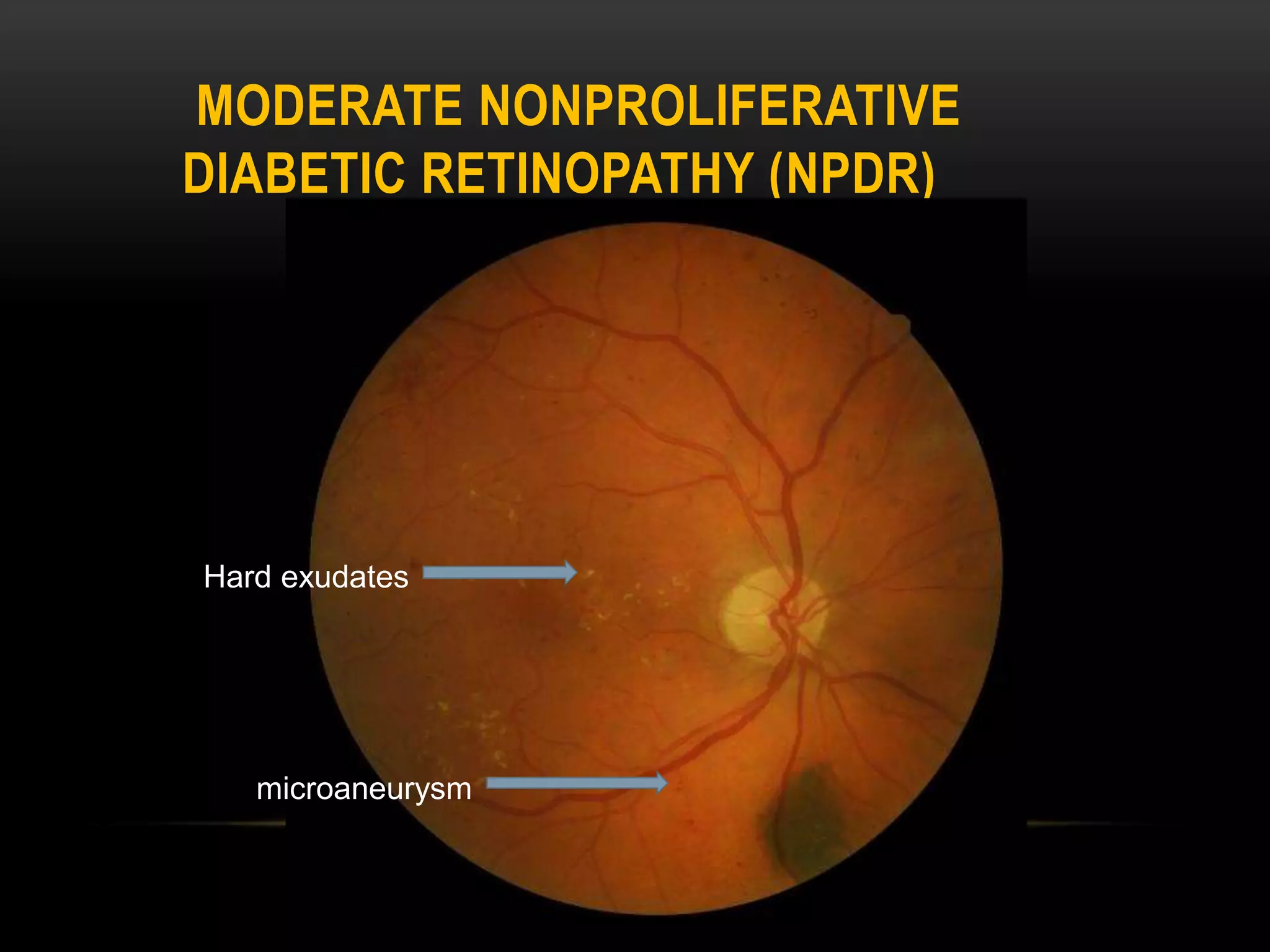 MODERATE NONPROLIFERATIVE
DIABETIC RETINOPATHY (NPDR)
Hard exudates
microaneurysm
 