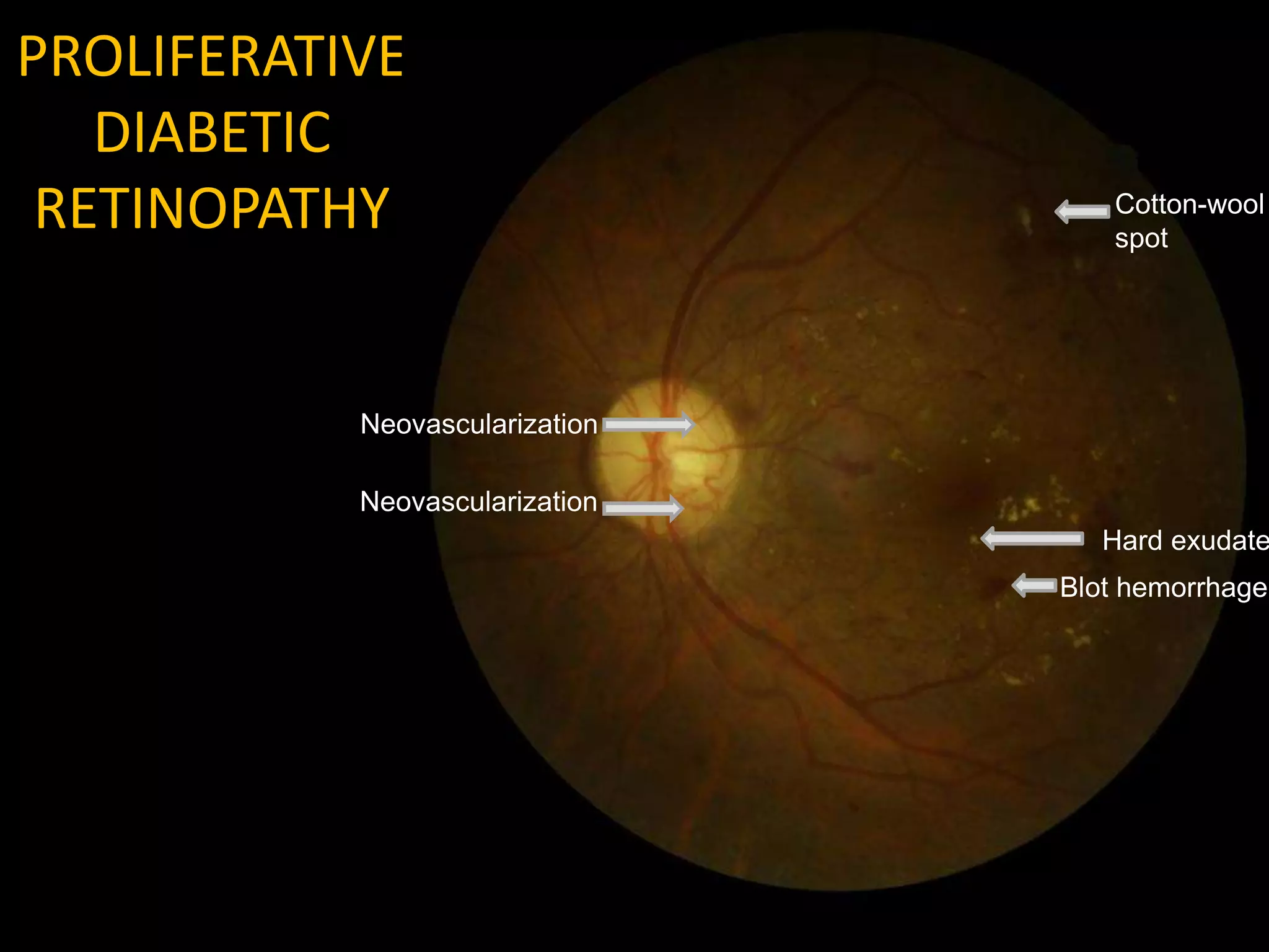 PROLIFERATIVE
DIABETIC
RETINOPATHY
Neovascularization
Neovascularization
Hard exudate
Cotton-wool
spot
Blot hemorrhage
 
