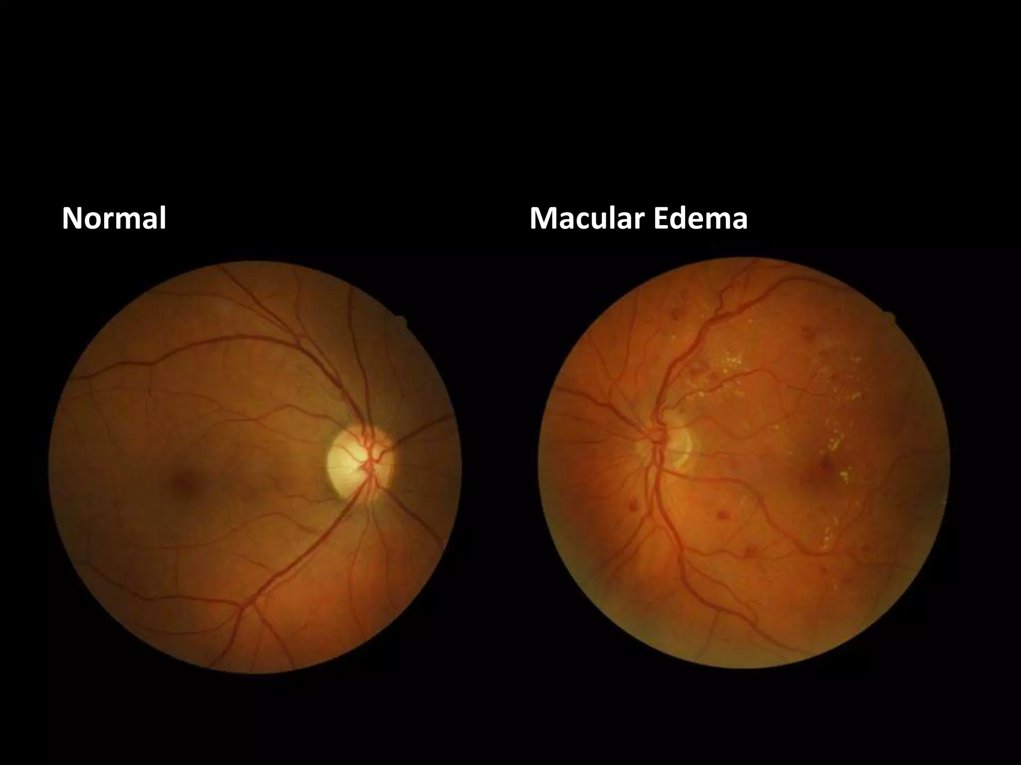 Normal Macular Edema
 