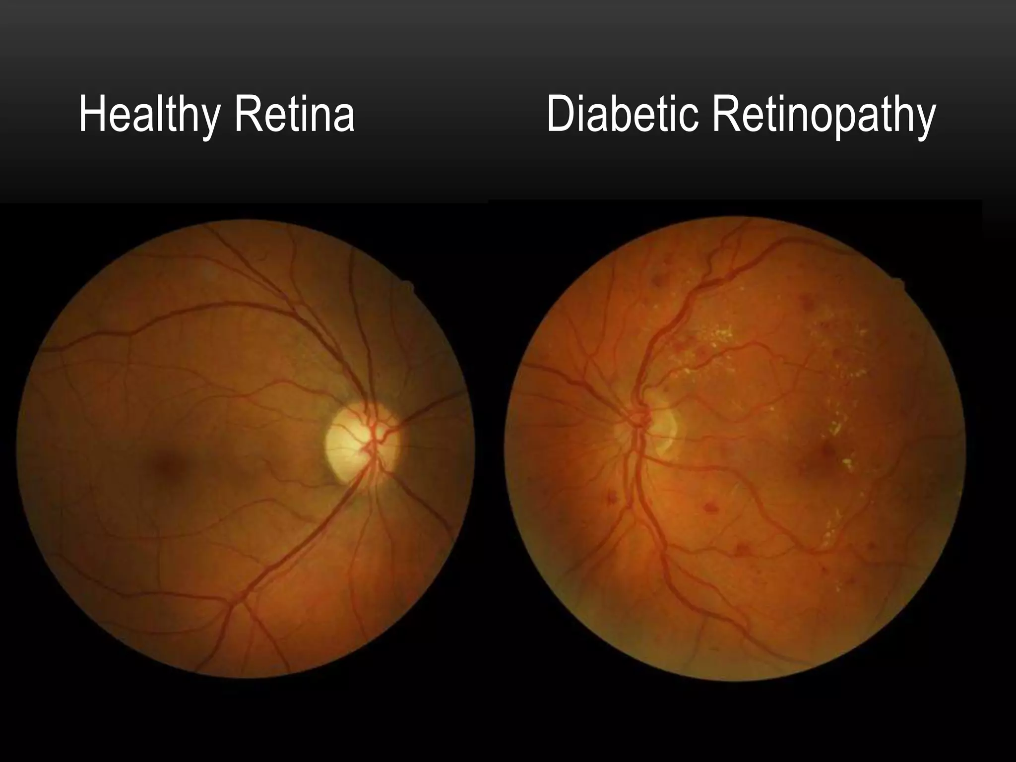 Healthy Retina Diabetic Retinopathy
 