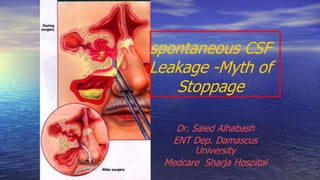 spontaneous CSF
Leakage -Myth of
Stoppage
Dr. Saied Alhabash
ENT Dep. Damascus
University
Medcare Sharja Hospital
 