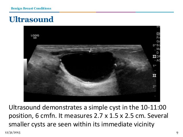 Benignt Conditions C View Images 9 Benignt Conditions C View Images 9