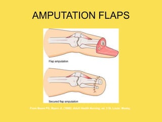AMPUTATION FLAPS
From Beare PG, Myers JL (1998): Adult Health Nursing, ed. 3 St. Louis: Mosby.
 