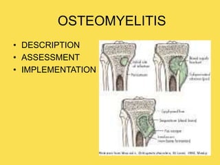 OSTEOMYELITIS
• DESCRIPTION
• ASSESSMENT
• IMPLEMENTATION
 