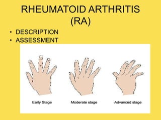 RHEUMATOID ARTHRITIS
(RA)
• DESCRIPTION
• ASSESSMENT
 