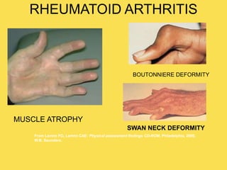 RHEUMATOID ARTHRITIS
From Lemmi FO, Lemmi CAE: Physical assessment findings CD-ROM, Philadelphia, 2000,
W.B. Saunders.
MUSCLE ATROPHY
BOUTONNIERE DEFORMITY
SWAN NECK DEFORMITY
 