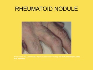 RHEUMATOID NODULE
From Lemmi FO, Lemmi CAE: Physical assessment findings CD-ROM, Philadelphia, 2000,
W.B. Saunders.
 