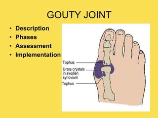 GOUTY JOINT
• Description
• Phases
• Assessment
• Implementation
 