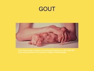GOUT
From Clinical Slide Collection of the Rheumatic Diseases, © 1991,1995,1997.
Used with permission of the American College of Rheumatology.
 