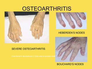 OSTEOARTHRITIS
From Kamal A, Brockelhurst J: Color atlas of geriatric medicine, ed. 2, St. Louis, 1991, Mosby.
SEVERE OSTEOARTHRITIS
HEBERDEN’S NODES
BOUCHARD’S NODES
 