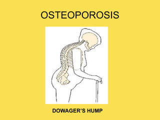 OSTEOPOROSIS
DOWAGER’S HUMP
 