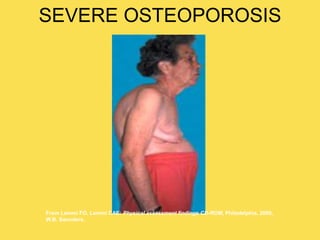 SEVERE OSTEOPOROSIS
From Lemmi FO, Lemmi CAE: Physical assessment findings CD-ROM, Philadelphia, 2000,
W.B. Saunders.
 