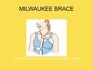 MILWAUKEE BRACE
From Mosby’s Medical, Nursing, and Allied Health Dictionary, ed 6, (2002). St. Louis: Mosby.
 