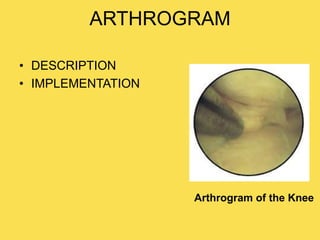 ARTHROGRAM
• DESCRIPTION
• IMPLEMENTATION
Arthrogram of the Knee
 