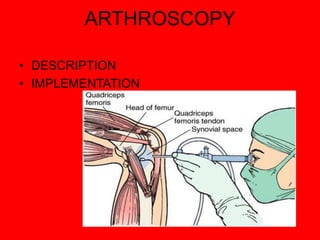 ARTHROSCOPY
• DESCRIPTION
• IMPLEMENTATION
 
