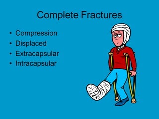 Complete Fractures
• Compression
• Displaced
• Extracapsular
• Intracapsular
 