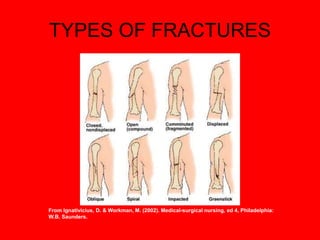 TYPES OF FRACTURES
From Ignativicius, D. & Workman, M. (2002). Medical-surgical nursing, ed 4, Philadelphia:
W.B. Saunders.
 