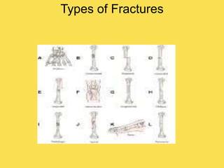 Types of Fractures
 