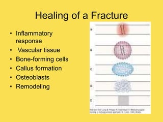 Healing of a Fracture
• Inflammatory
response
• Vascular tissue
• Bone-forming cells
• Callus formation
• Osteoblasts
• Remodeling
 