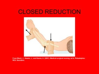 CLOSED REDUCTION
From Black, J., Hawks, J., and Keene, A. (2001). Medical-surgical nursing, ed 6, Philadelphia:
W.B. Saunders.
 