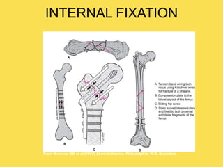 INTERNAL FIXATION
From Browner BB et al (1992) Skeletal trauma. Philadelphia: W.B. Saunders.
 