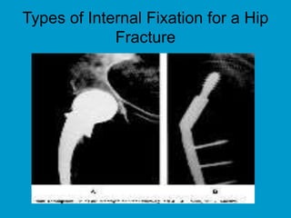 Types of Internal Fixation for a Hip
Fracture
 