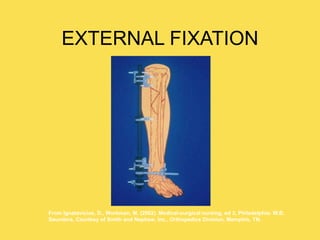 EXTERNAL FIXATION
From Ignatavicius, D., Workman, M. (2002). Medical-surgical nursing, ed 3, Philadelphia: W.B.
Saunders. Courtesy of Smith and Nephew, Inc., Orthopedics Division, Memphis, TN.
 