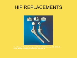HIP REPLACEMENTS
From Mosby’s Medical, Nursing, and Allied Health Dictionary, ed 6, (2002). St.
Louis: Mosby. Courtesy of Zimmer, Inc., Warsaw, IN.
 