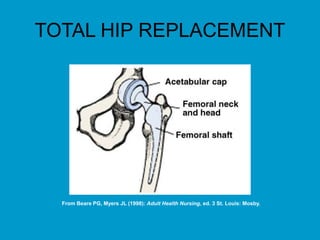 TOTAL HIP REPLACEMENT
From Beare PG, Myers JL (1998): Adult Health Nursing, ed. 3 St. Louis: Mosby.
 