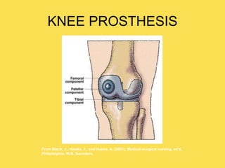 KNEE PROSTHESIS
From Black, J., Hawks, J., and Keene, A. (2001). Medical-surgical nursing, ed 6,
Philadelphia: W.B. Saunders.
 