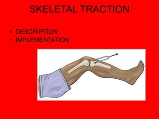 SKELETAL TRACTION
• DESCRIPTION
• IMPLEMENTATION
 