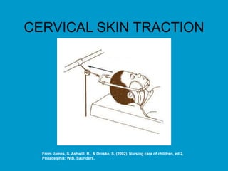 CERVICAL SKIN TRACTION
From James, S. Ashwill, R., & Droske, S. (2002). Nursing care of children, ed 2,
Philadelphia: W.B. Saunders.
 
