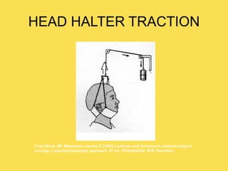 HEAD HALTER TRACTION
From Black JM, Matassarin-Jacobs E (1993) Luckman and Sorensen’s medical-surgical
nursing: a psychophysiologic approach, 4th ed., Philadelphia: W.B. Saunders.
 