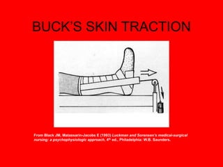 BUCK’S SKIN TRACTION
From Black JM, Matassarin-Jacobs E (1993) Luckman and Sorensen’s medical-surgical
nursing: a psychophysiologic approach, 4th ed., Philadelphia: W.B. Saunders.
 