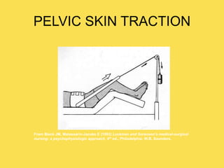 PELVIC SKIN TRACTION
From Black JM, Matassarin-Jacobs E (1993) Luckman and Sorensen’s medical-surgical
nursing: a psychophysiologic approach, 4th ed., Philadelphia: W.B. Saunders.
 