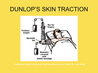 DUNLOP’S SKIN TRACTION
From Mosby’s Medical, Nursing, and Allied Health Dictionary, ed 6, (2002). St. Louis: Mosby.
 