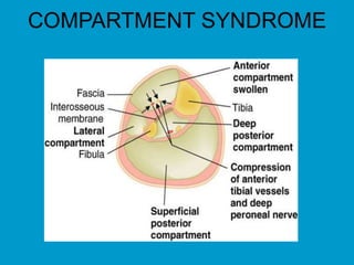 COMPARTMENT SYNDROME
 