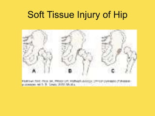 Soft Tissue Injury of Hip
 