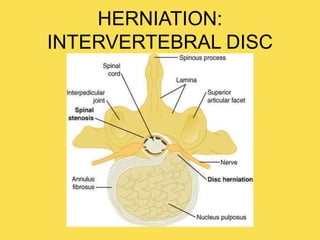 HERNIATION:
INTERVERTEBRAL DISC
 