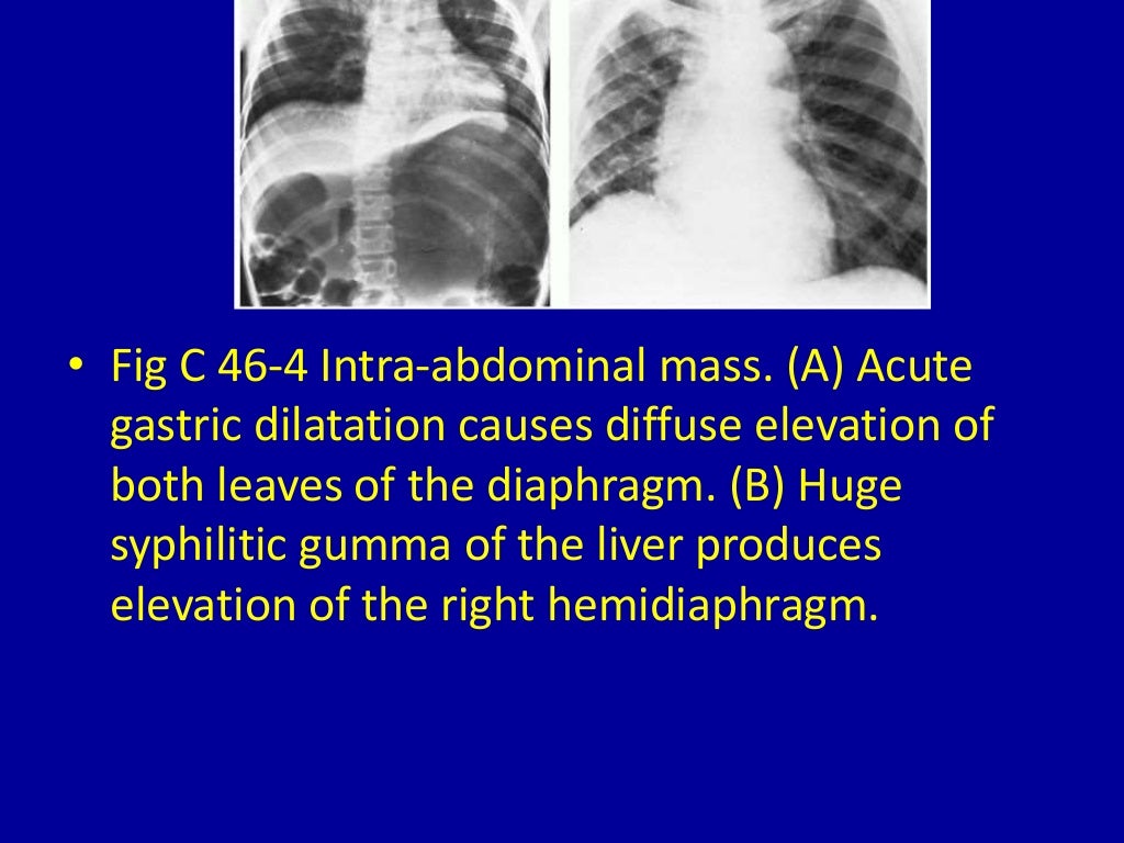46 elevated diaphragm
