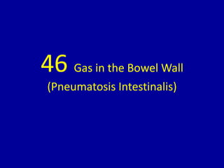 46 Gas in the Bowel Wall
(Pneumatosis Intestinalis)
 