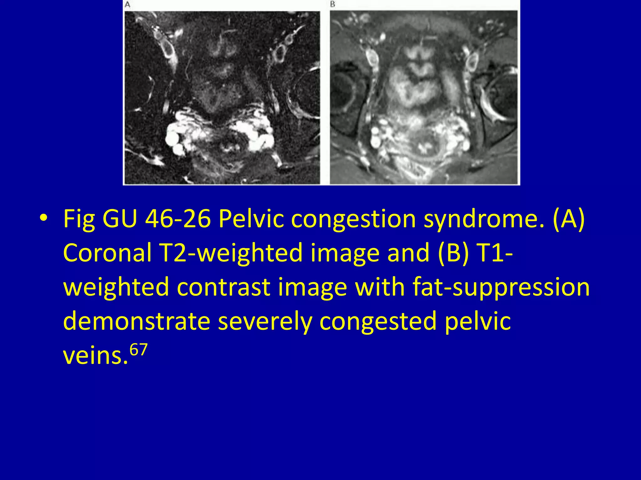 46 magnetic resonance imaging of the female pelvis | PPTX