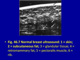 • Fig. 46.7 Normal breast ultrasound: 1 = skin;
2 = subcutaneous fat; 3 = glandular tissue; 4 =
retromammary fat; 5 = pectoralis muscle; 6 =
rib.
 
