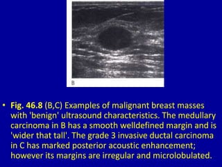 • Fig. 46.8 (B,C) Examples of malignant breast masses
with 'benign' ultrasound characteristics. The medullary
carcinoma in B has a smooth welldefined margin and is
'wider that tall'. The grade 3 invasive ductal carcinoma
in C has marked posterior acoustic enhancement;
however its margins are irregular and microlobulated.
 