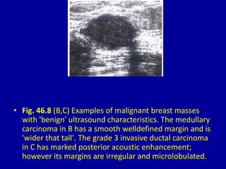 • Fig. 46.8 (B,C) Examples of malignant breast masses
with 'benign' ultrasound characteristics. The medullary
carcinoma in B has a smooth welldefined margin and is
'wider that tall'. The grade 3 invasive ductal carcinoma
in C has marked posterior acoustic enhancement;
however its margins are irregular and microlobulated.
 